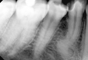 Дентална клиника Дамянов Един случай на „невъзможен зъб“ 