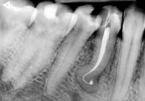 Дентална клиника Дамянов Един случай на „невъзможен зъб“ 