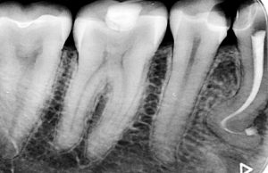 Дентална клиника Дамянов Един случай на „невъзможен зъб“ 