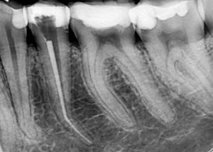 Дентална клиника Дамянов Перфорация на зъбен корен, съчетана със счупен инструмент Перфорация на зъбен корен