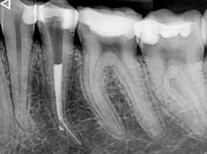 Дентална клиника Дамянов Перфорация на зъбен корен, съчетана със счупен инструмент Перфорация на зъбен корен