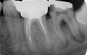 Дентална клиника Дамянов Лечение на коренови канали 