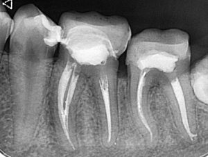 Дентална клиника Дамянов Лечение на коренови канали 